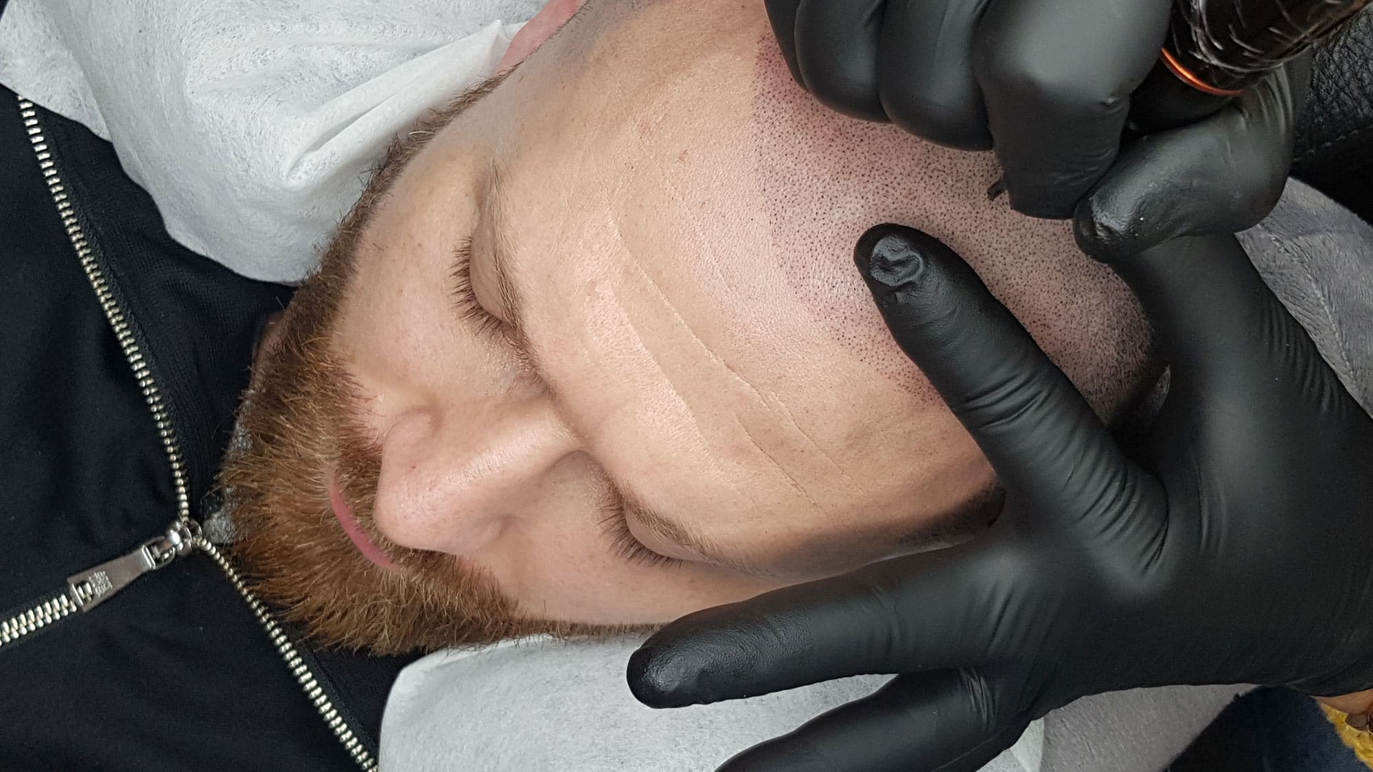 scalp micropigmentation portugal